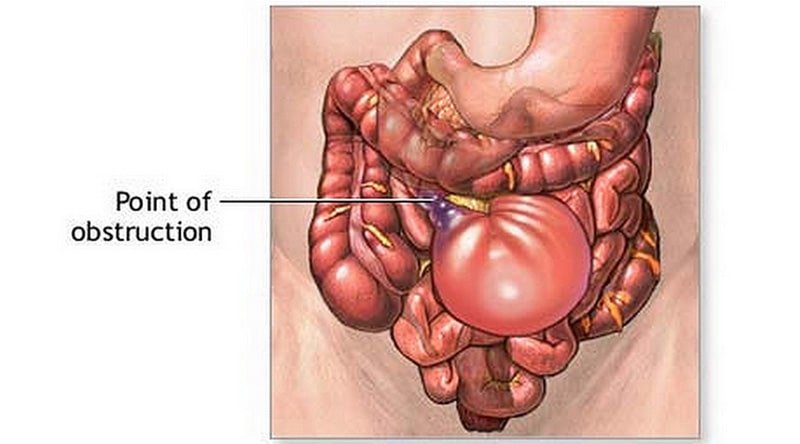 Bowel Intestinal Obstruction | CHAPTER-6 | Medical and Surgical Nursing