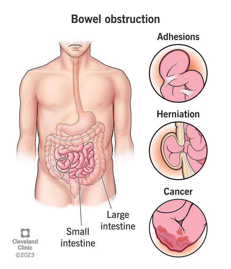 Bowel Intestinal Obstruction | CHAPTER-6 | Medical and Surgical Nursing