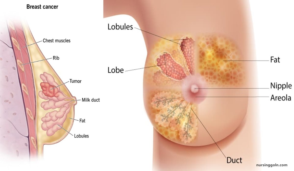 Breast cancer | CHAPTER-12 | Medical and Surgical Nursing