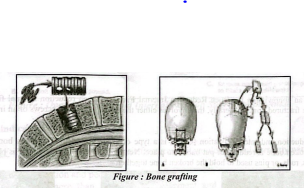 Bone Grafting | CHAPTER 7 | Orthopedic Nursing