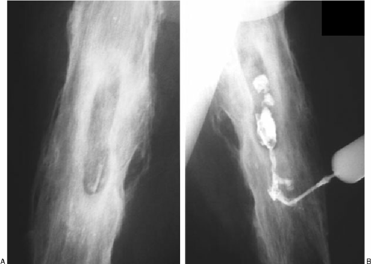 Definition of Amputation | CHAPTER 8 | Orthopedic Nursing