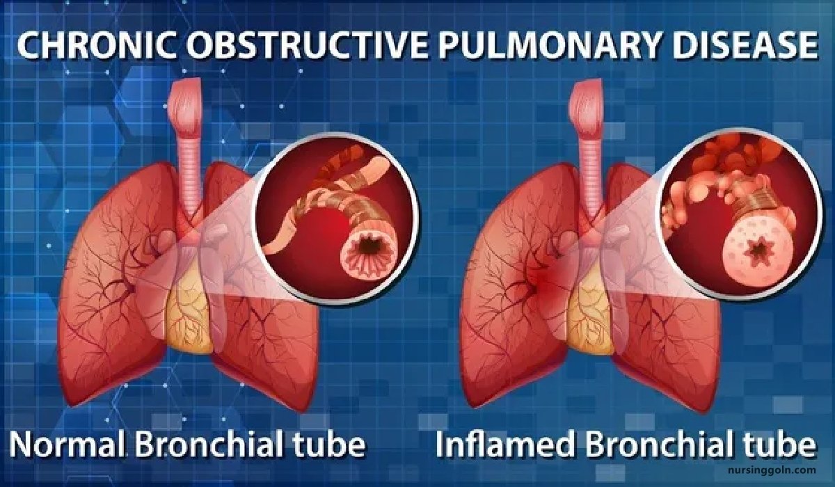 Chronie Obstructive Pulmonary Disease (COPD) | CHAPTER-8 | Medical and Surgical Nursing