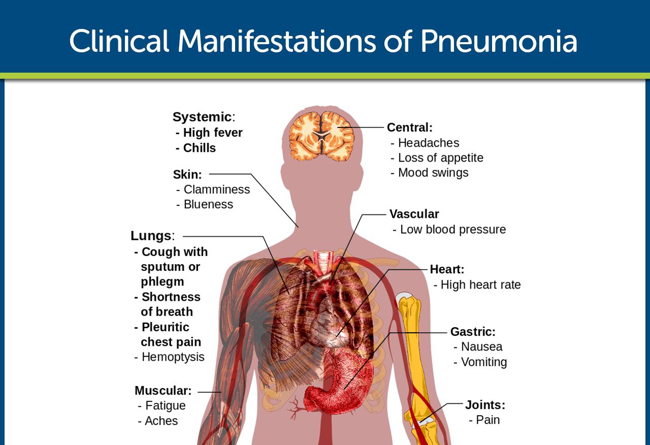 Concepts of Pneumonia | CHAPTER 6 | Pediatric Nursing