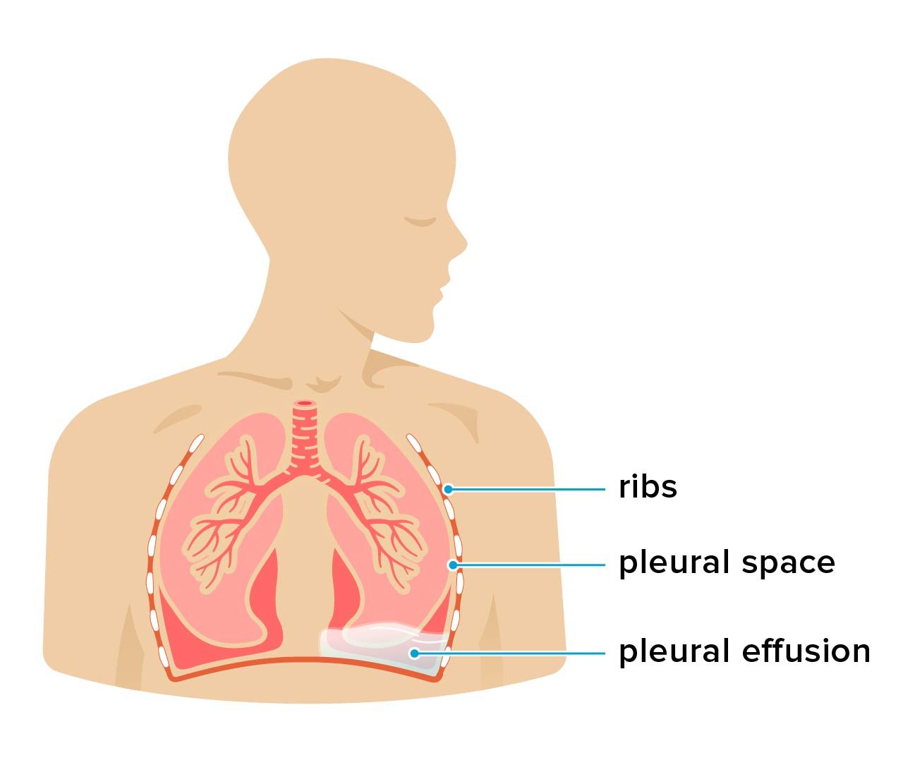Concept About Pleural Effusion