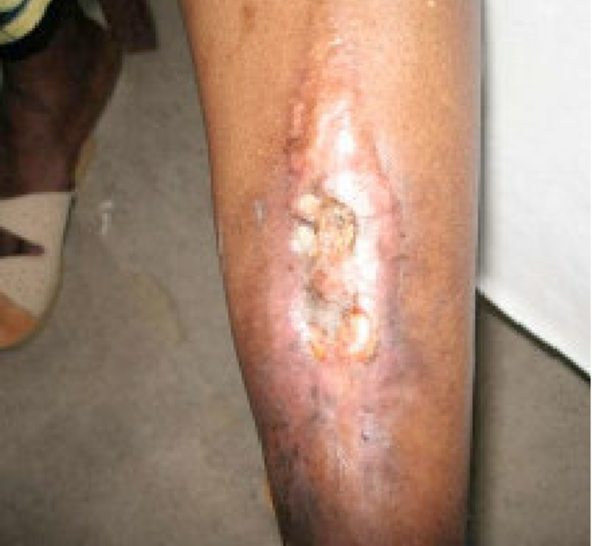 Concept about Osteomyelitis | CHAPTER 14 | Orthopedic Nursing