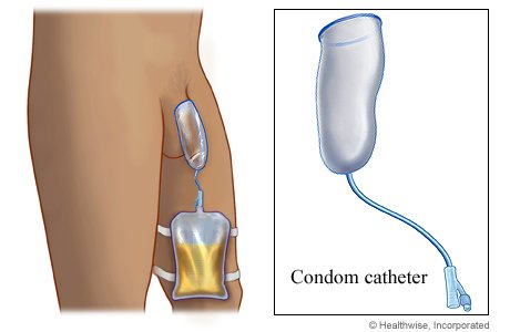 urinary catheterization