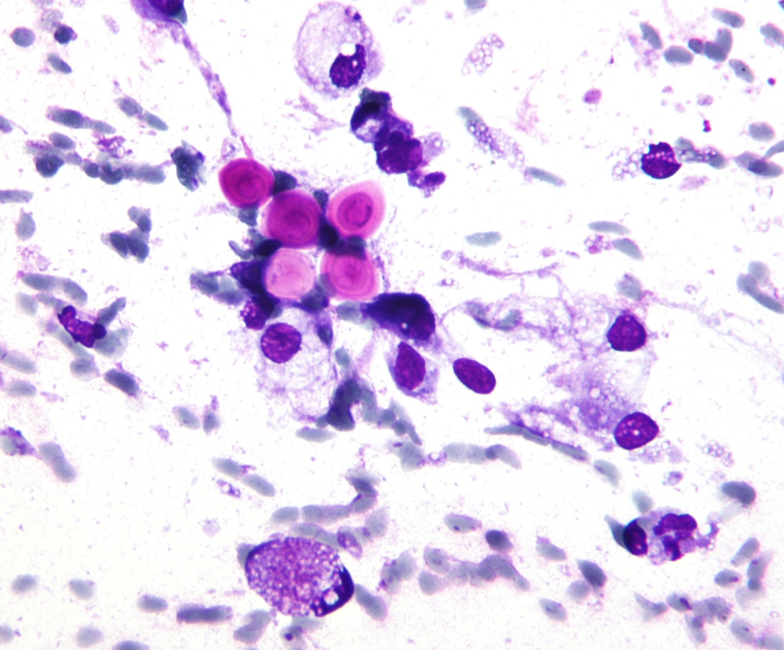 Crypotococcus Neoformans