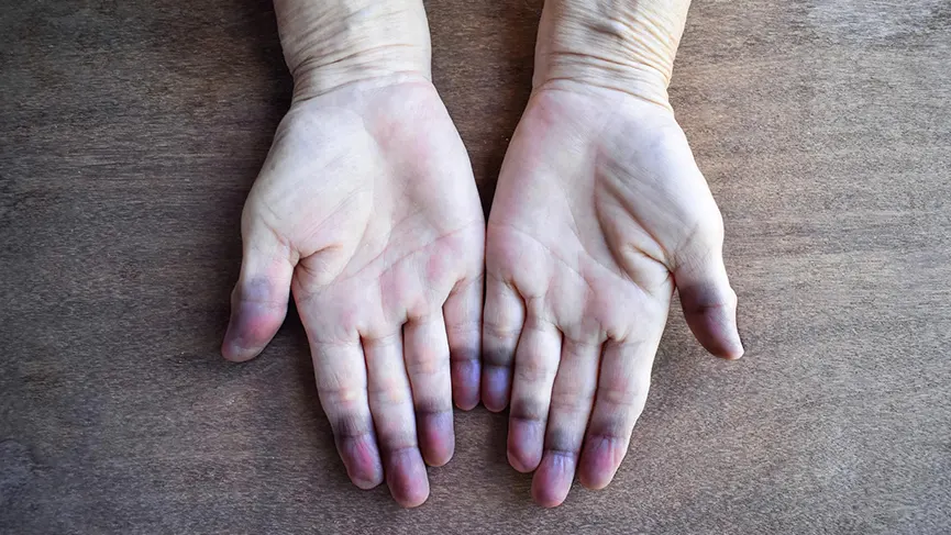 Definition of Cyanosis | CHAPTER-19: General Examination | Fundamentals of Nursing