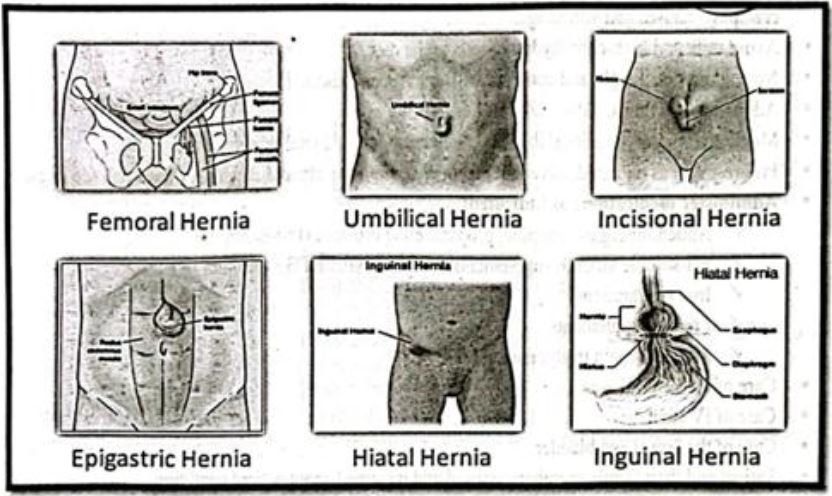 Definition of Hernia | CHAPTER-6 | Medical and Surgical Nursing