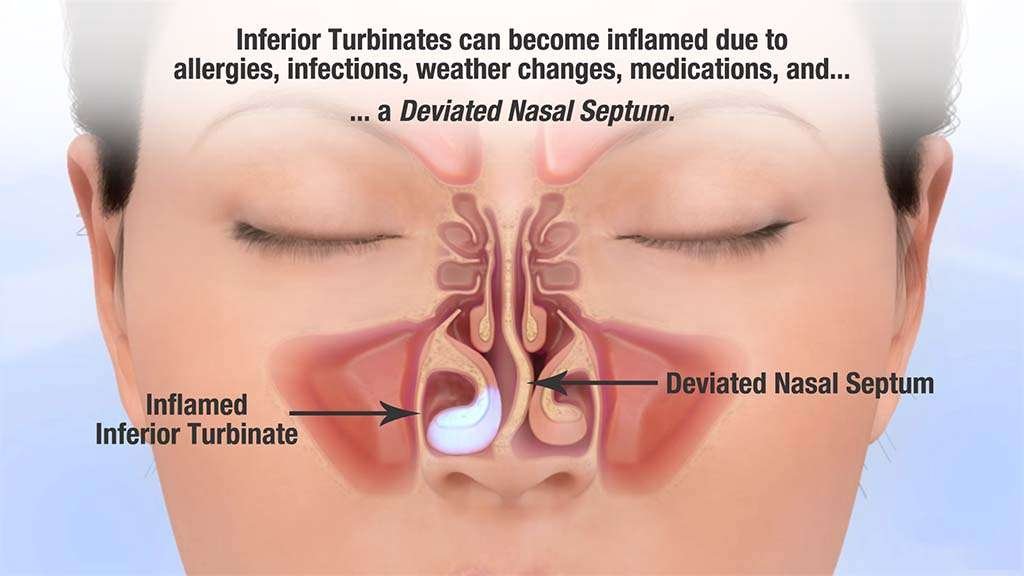 Deviated Nasal Septum