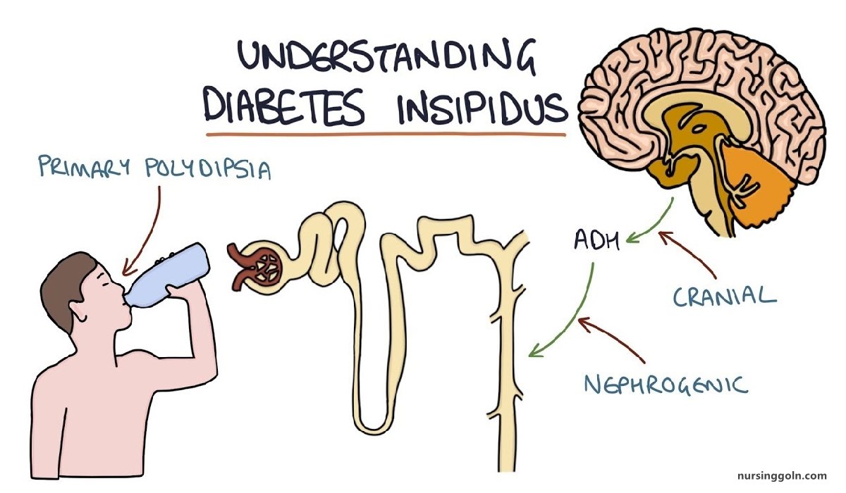 Diabetes Insipidus | CHAPTER-15 | Medical and Surgical Nursing