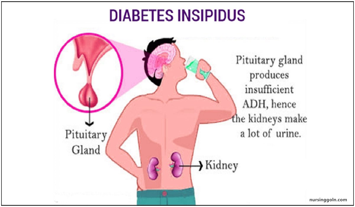 Diabetes Insipidus | CHAPTER-15 | Medical and Surgical Nursing
