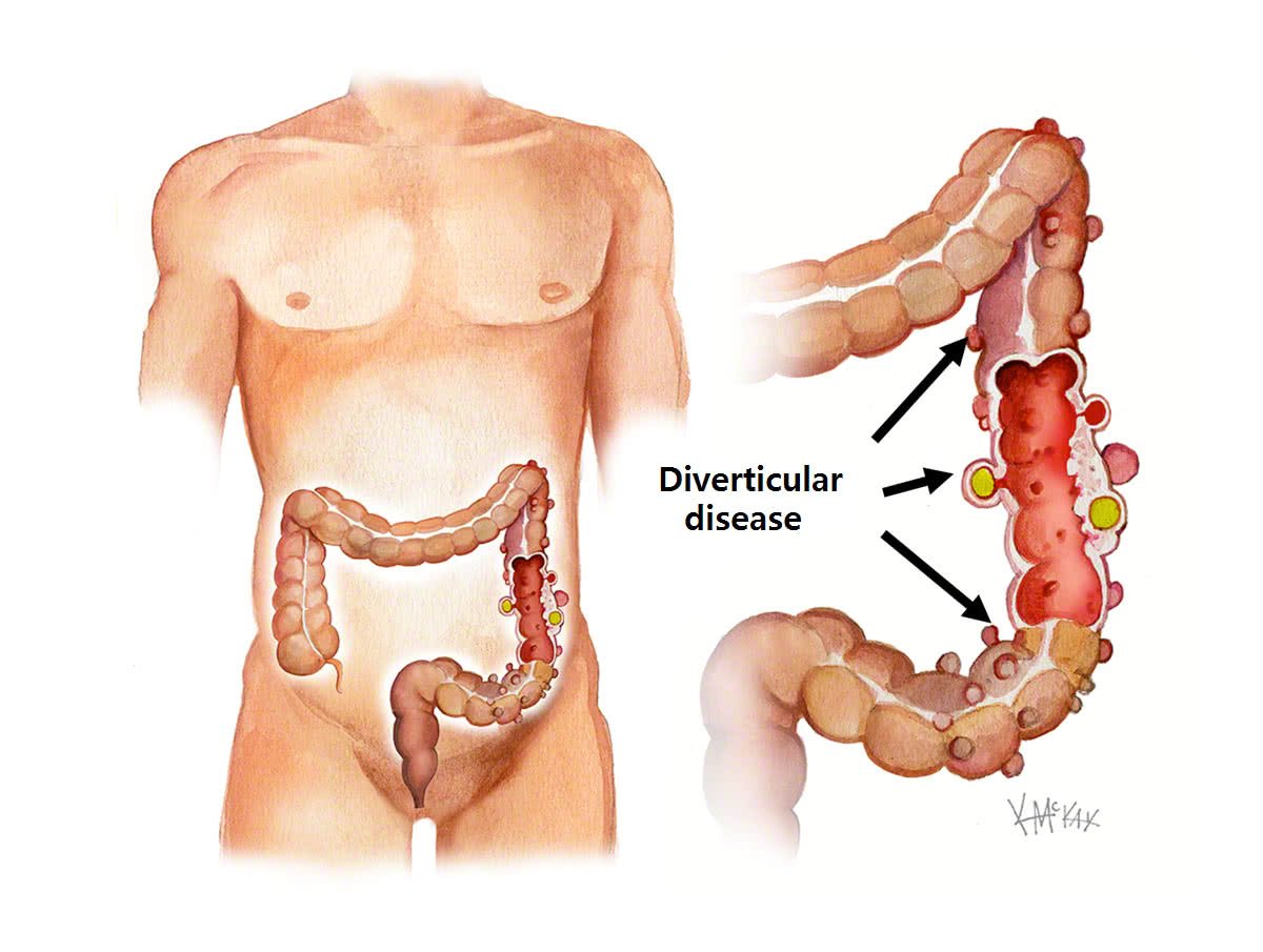 Diverticular disease | CHAPTER-6 | Medical and Surgical Nursing