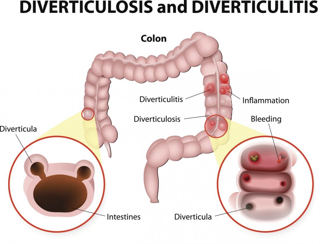 Definition of Diverticulitis | CHAPTER-6 | Medical and Surgical Nursing