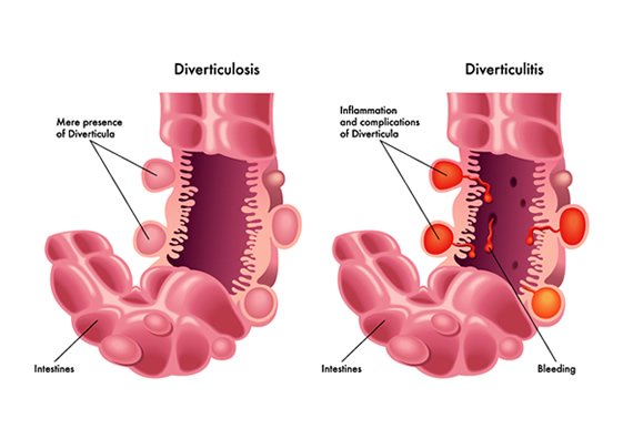 Definition of Diverticulosis | CHAPTER-6 | Medical and Surgical Nursing