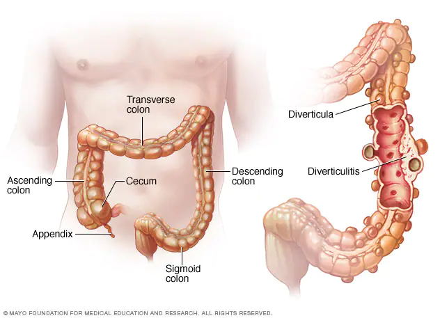 Definition of Diverticulosis | CHAPTER-6 | Medical and Surgical Nursing