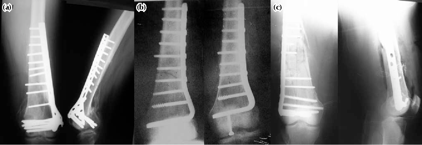 Fracture of Neck of Femur (NOF) | CHAPTER 5 | Orthopedic Nursing