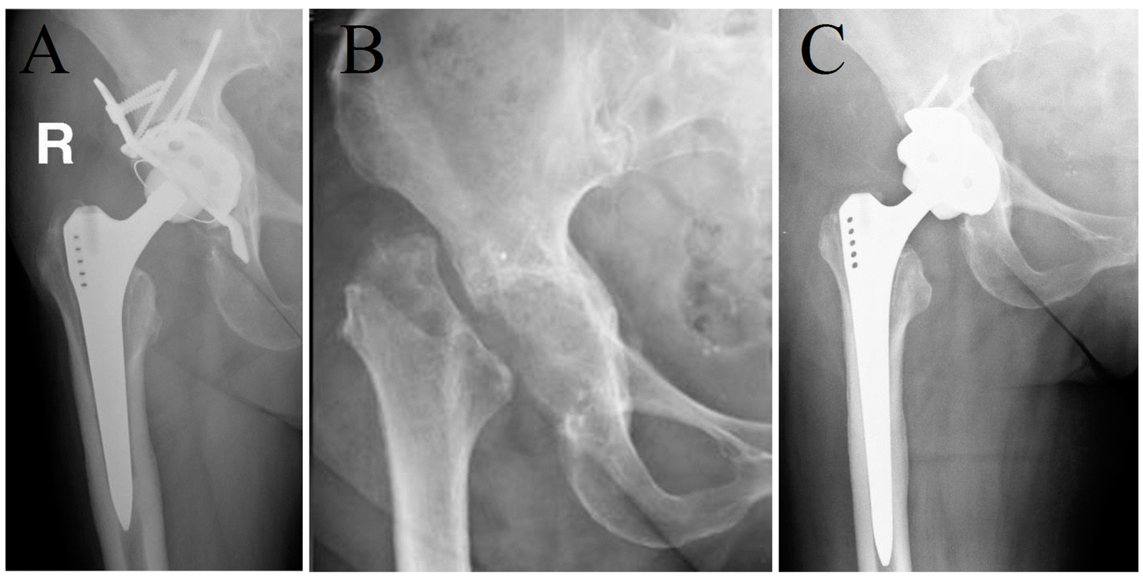 Hip arthoplasty | CHAPTER 11 | Orthopedic Nursing