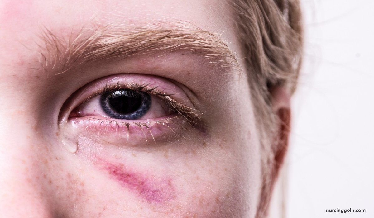 Eye injury | CHAPTER-10 | Medical and Surgical Nursing