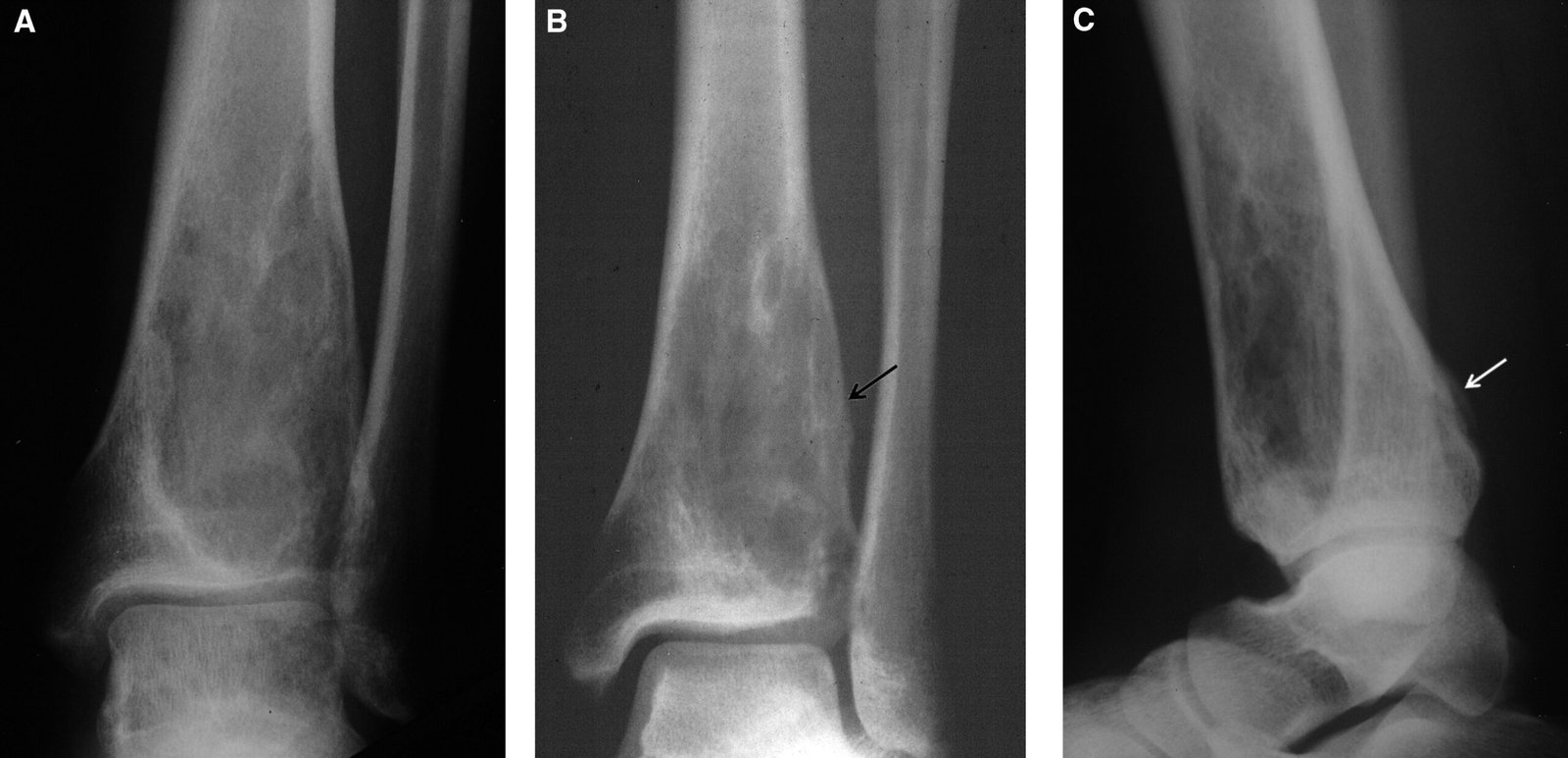 Concept about Osteosarcoma | CHAPTER 15 | Orthopedic Nursing