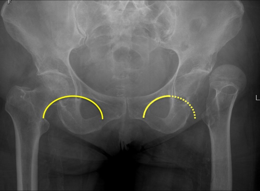 Fracture of Neck of Femur (NOF) | CHAPTER 5 | Orthopedic Nursing