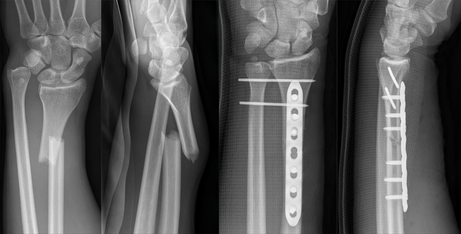 Fracture of radius & Ulna | CHAPTER 5 | Orthopedic Nursing