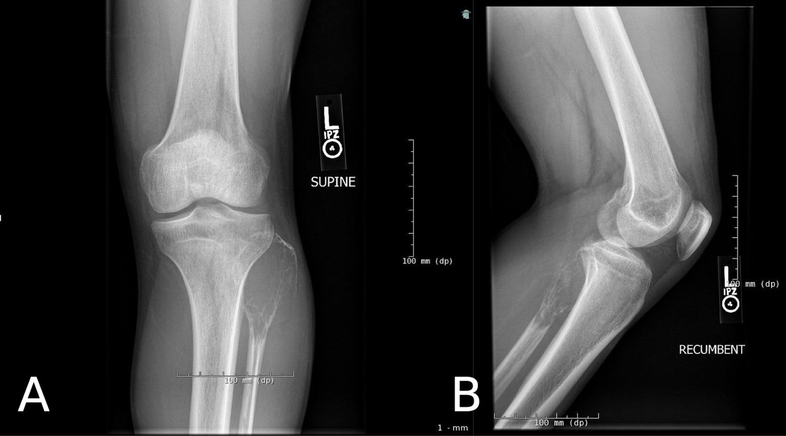 Giant Cell Tumor | CHAPTER 16 | Orthopedic Nursing