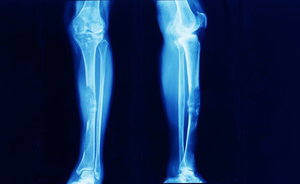 Giant Cell Tumor | CHAPTER 16 | Orthopedic Nursing
