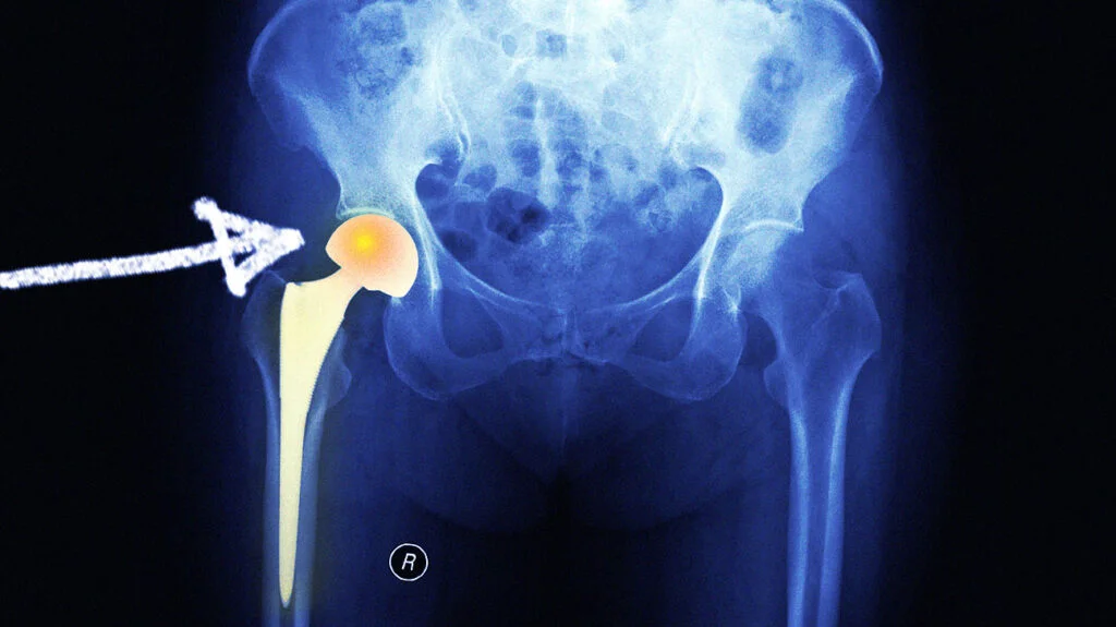 Hip arthoplasty | CHAPTER 11 | Orthopedic Nursing