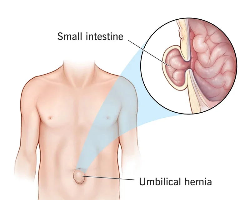 Definition of Hernia | CHAPTER-6 | Medical and Surgical Nursing