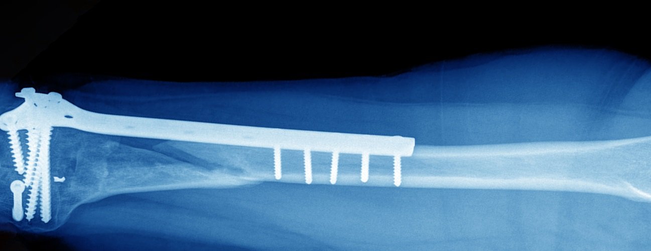 Internal Fixations | CHAPTER 8 | Orthopedic Nursing