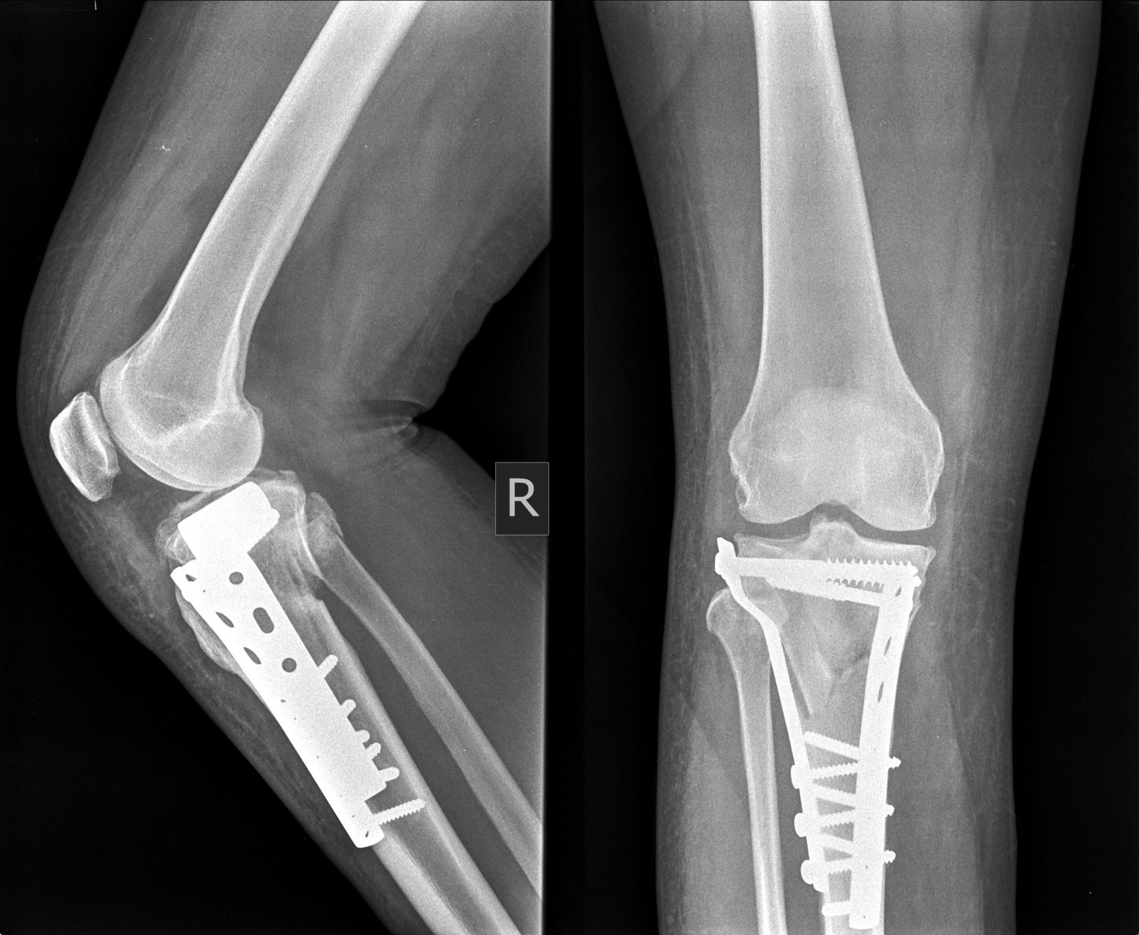 Internal Fixations | CHAPTER 8 | Orthopedic Nursing