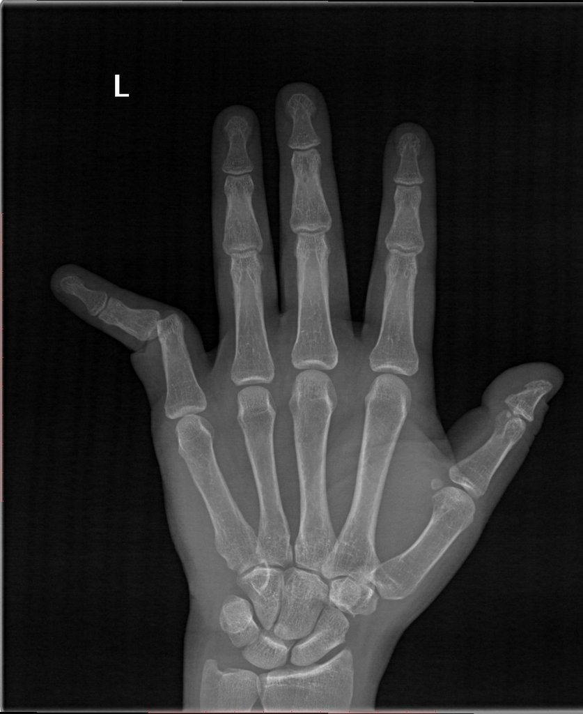 Interphalangeal joint dislocation