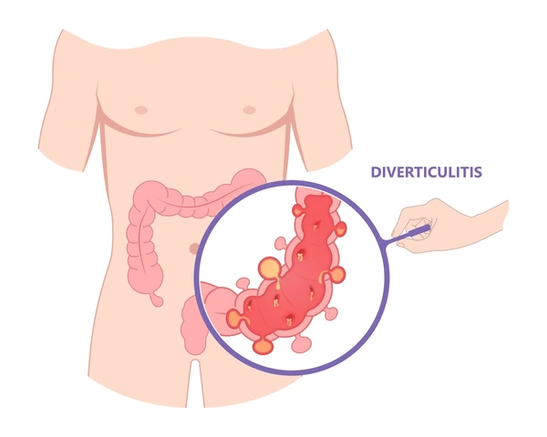 Intestinal perforation | CHAPTER-6 | Medical and Surgical Nursing