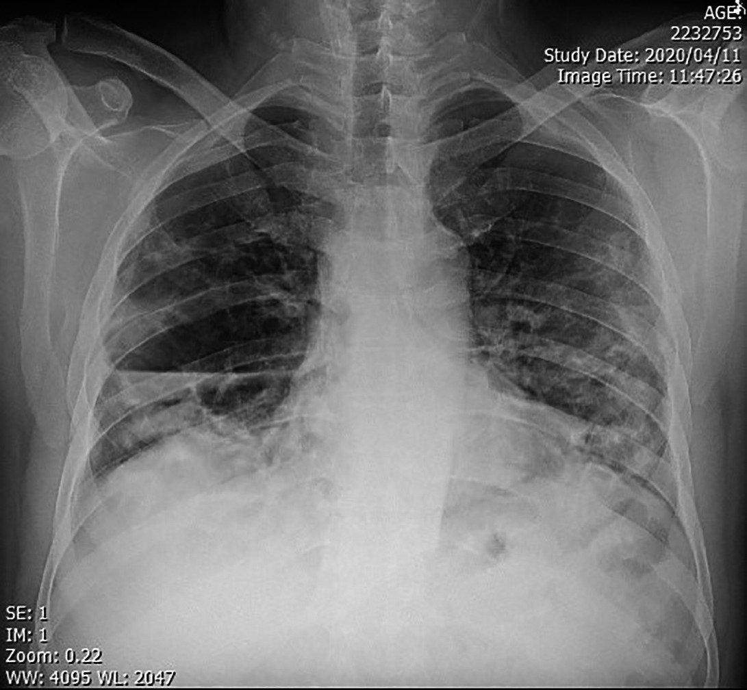 Lung Abscess | CHAPTER-8 | Medical and Surgical Nursing