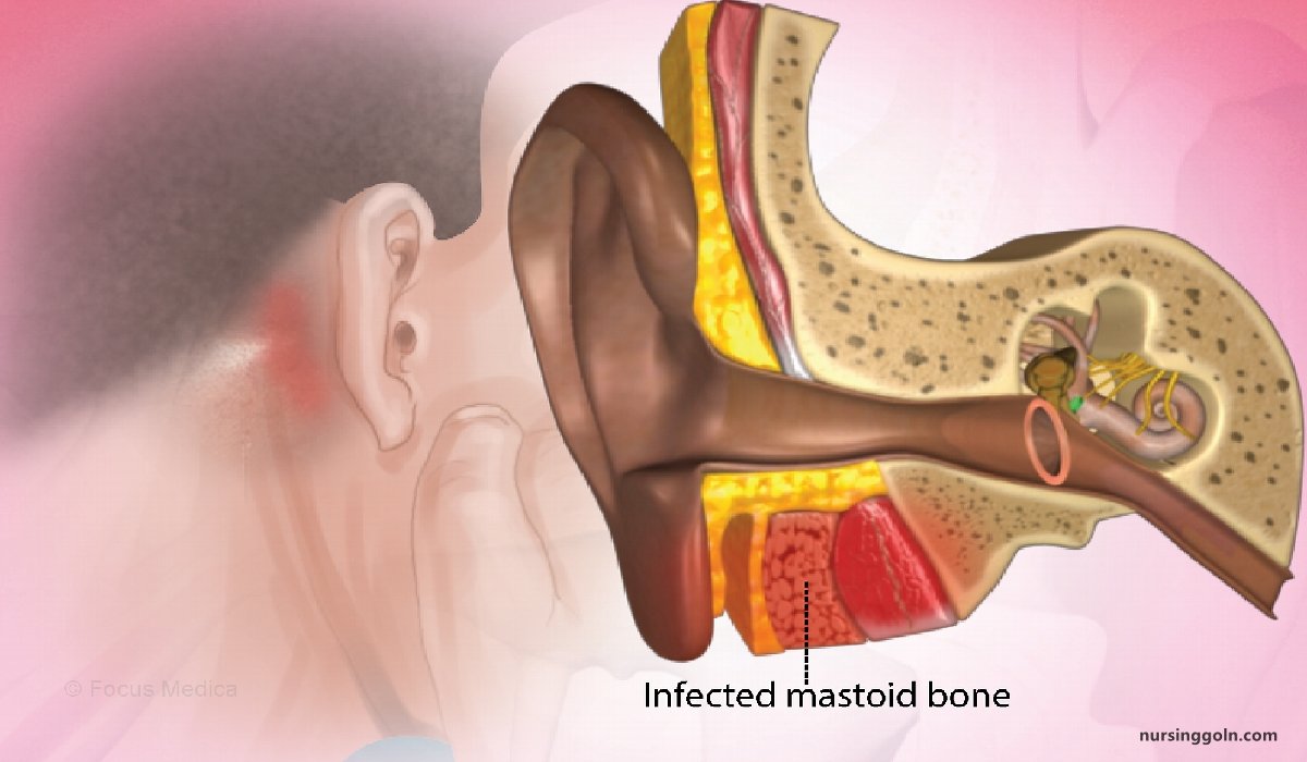 Definition of Mastoiditis | CHAPTER-10 | Medical and Surgical Nursing