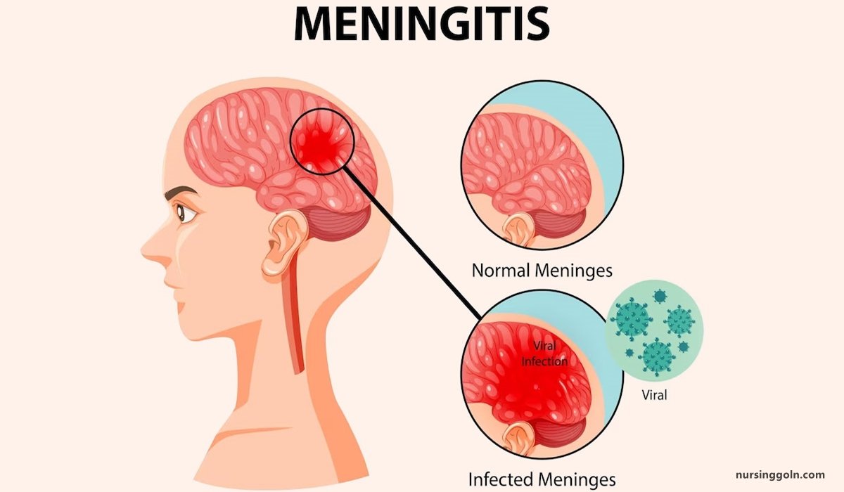 Concept of Meningitis | CHAPTER-14 | Medical and Surgical Nursing