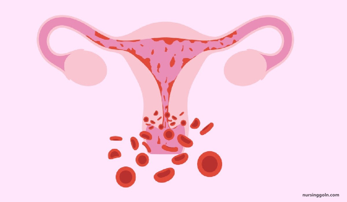 Concept of Menorrhagia | CHAPTER-17 | Medical and Surgical Nursing