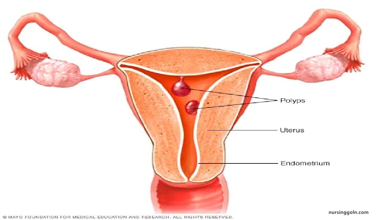 Concept of Menorrhagia | CHAPTER-17 | Medical and Surgical Nursing