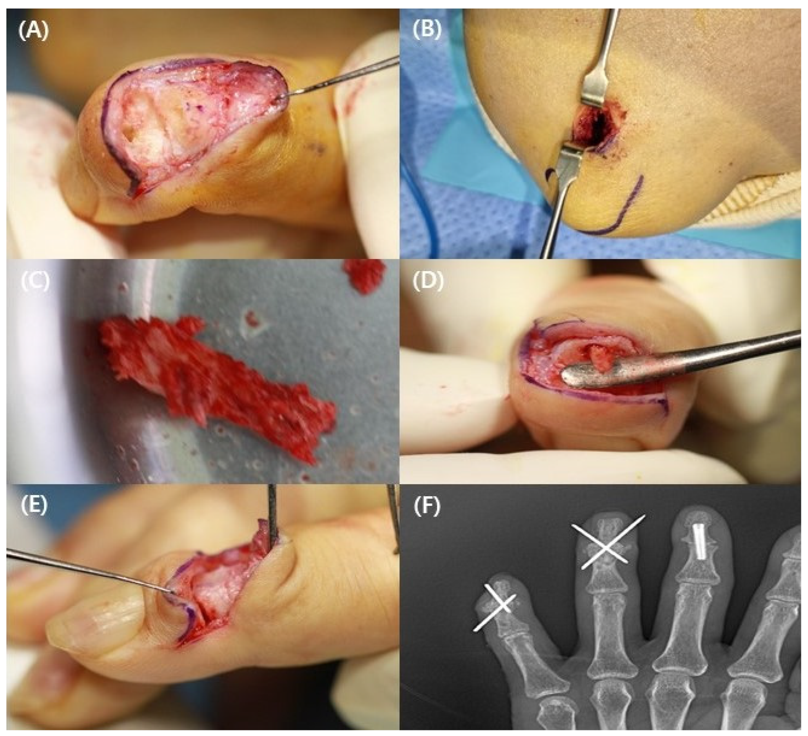 Definition of Arthrodesis | CHAPTER 10 | Orthopedic Nursing