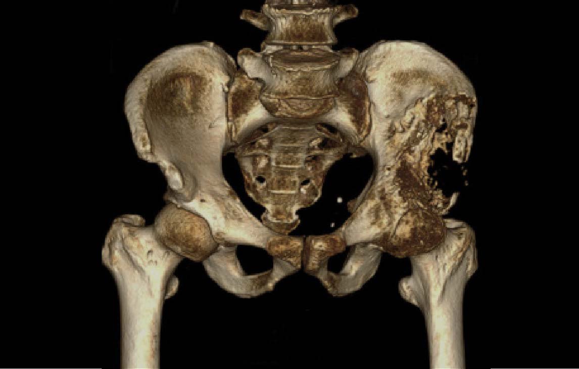 Metastatic Bone Disease | CHAPTER 16 | Orthopedic Nursing