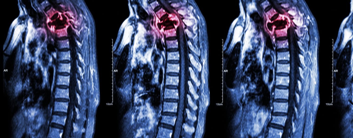 Metastatic Bone Disease | CHAPTER 16 | Orthopedic Nursing