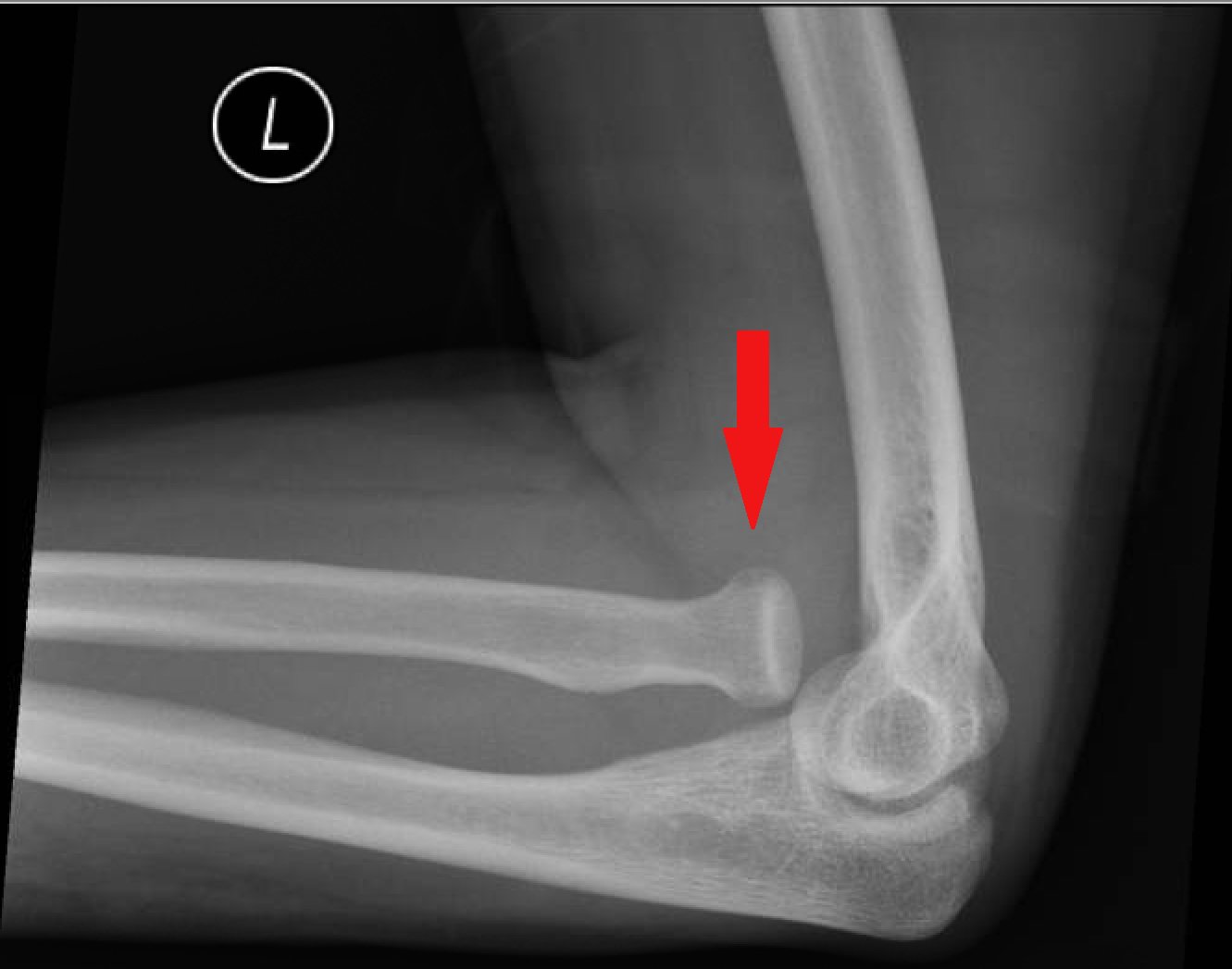 Monteggia fracture | CHAPTER 5 | Orthopedic Nursing