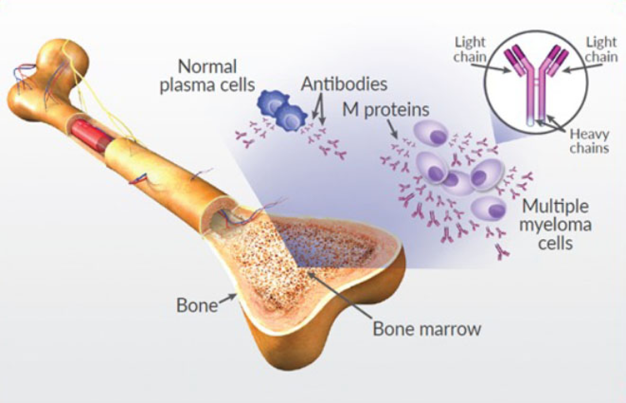 Multiple myeloma | CHAPTER 16 | Orthopedic Nursing