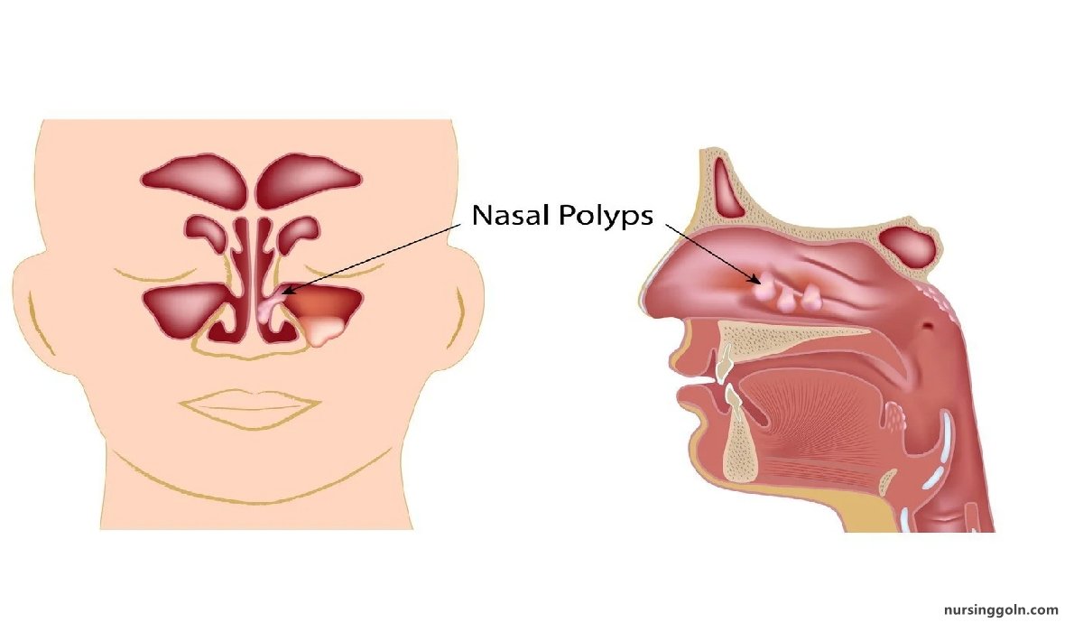 Nasal polyps | CHAPTER-10 | Medical and Surgical Nursing
