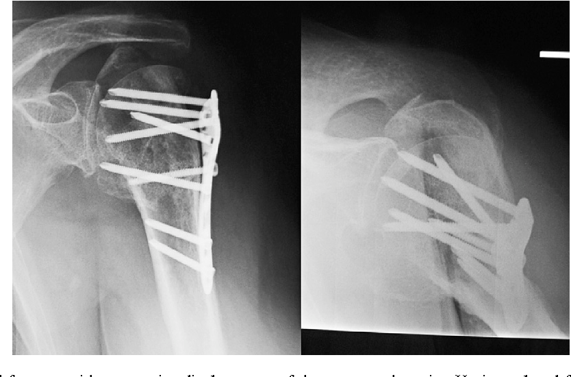 Definition ORIF | CHAPTER 7 | Orthopedic Nursing
