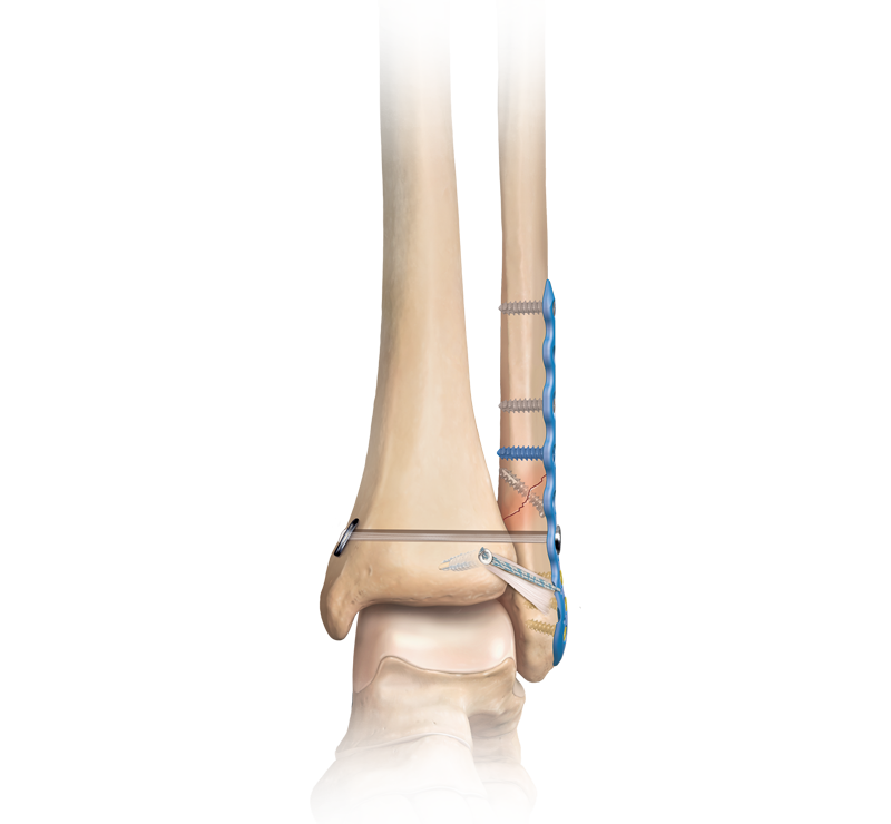 Definition ORIF | CHAPTER 7 | Orthopedic Nursing