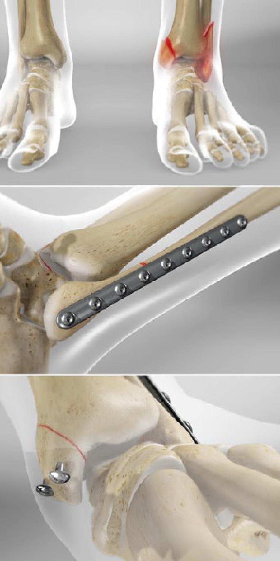 Open Reduction and Internal Fixation Surgery of the Ankle