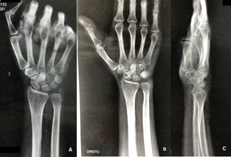 Concept about Osteoblastoma | CHAPTER 16 | Orthopedic Nursing