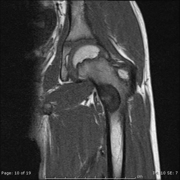 Concept about Osteoblastoma | CHAPTER 16 | Orthopedic Nursing
